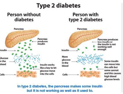 Type 2 Diabetes